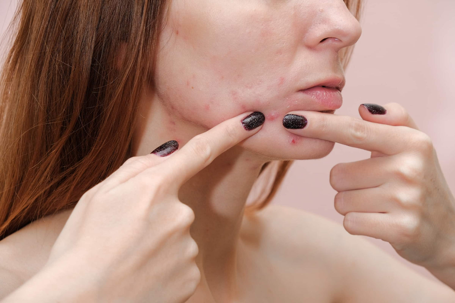 Top 5 Acne Skincare Myths